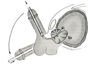 Esquema da cirurxía endoscópica de ampliación do pene