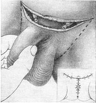 Alongamento cirúrxico do pene tirando da súa parte oculta