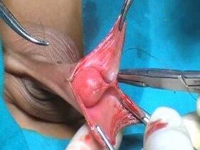 Cirurxía de ampliación do pene masculino